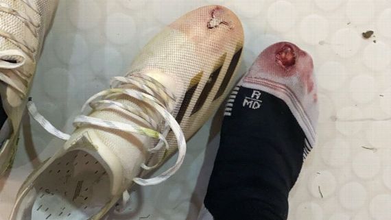 Campeón a sangre y fuego. Córdova muestra las huellas de la final